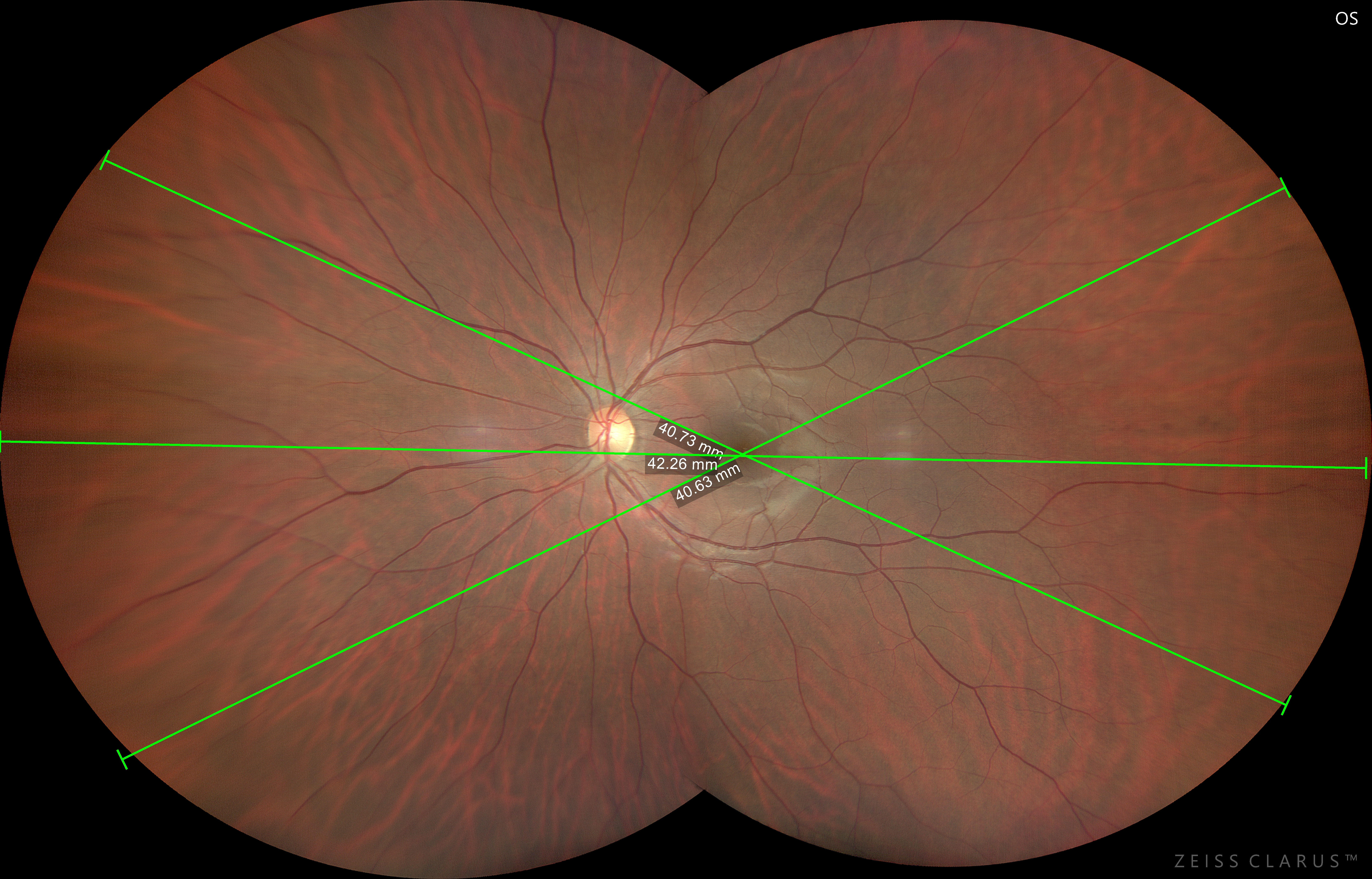 Imaging  retinico a 2 shot con Clarus 500 Zeiss